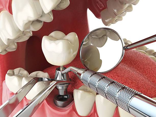 Best Chipped Tooth Repair Near Me  in Stuarts Draft, VA